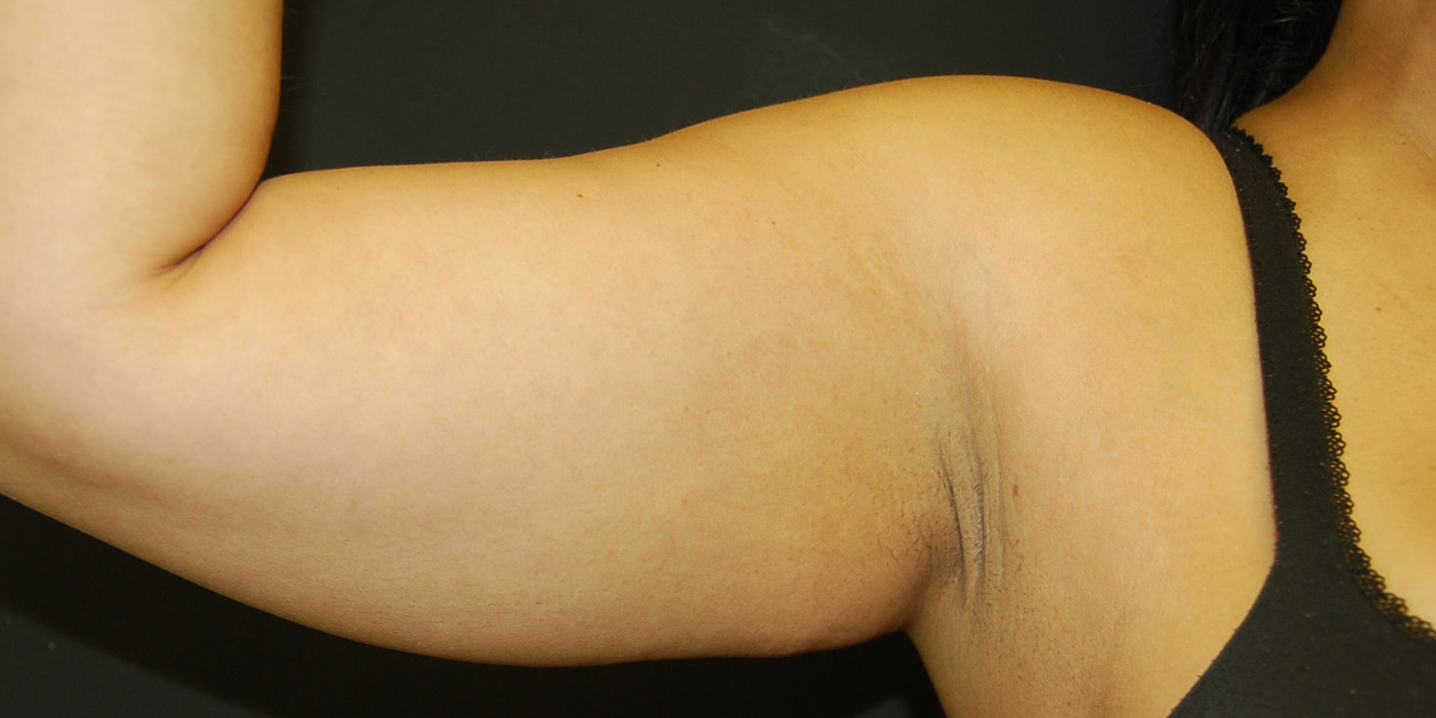 Arm Lift Before