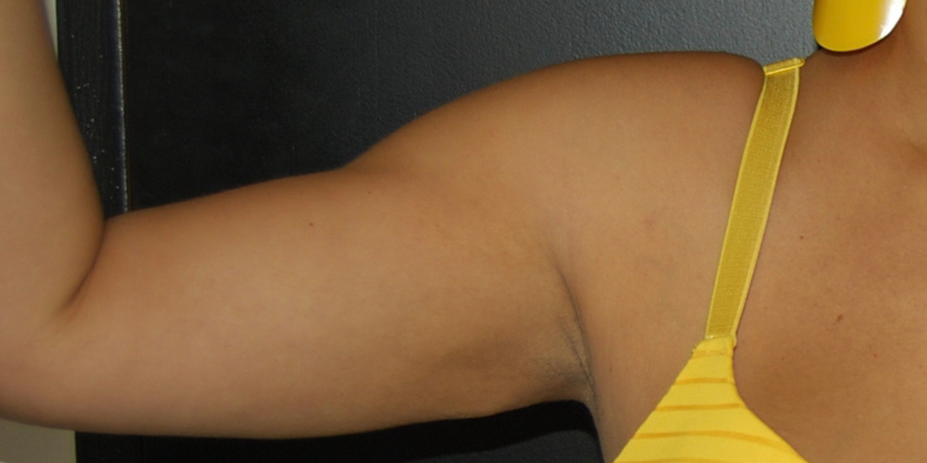 Arm Lift Surgery <br> (Brachioplasty)