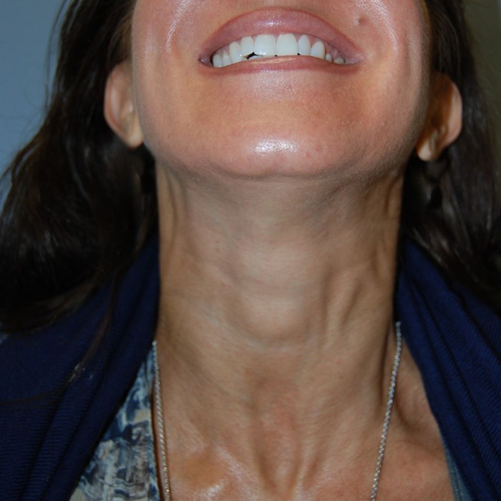 Botox, After