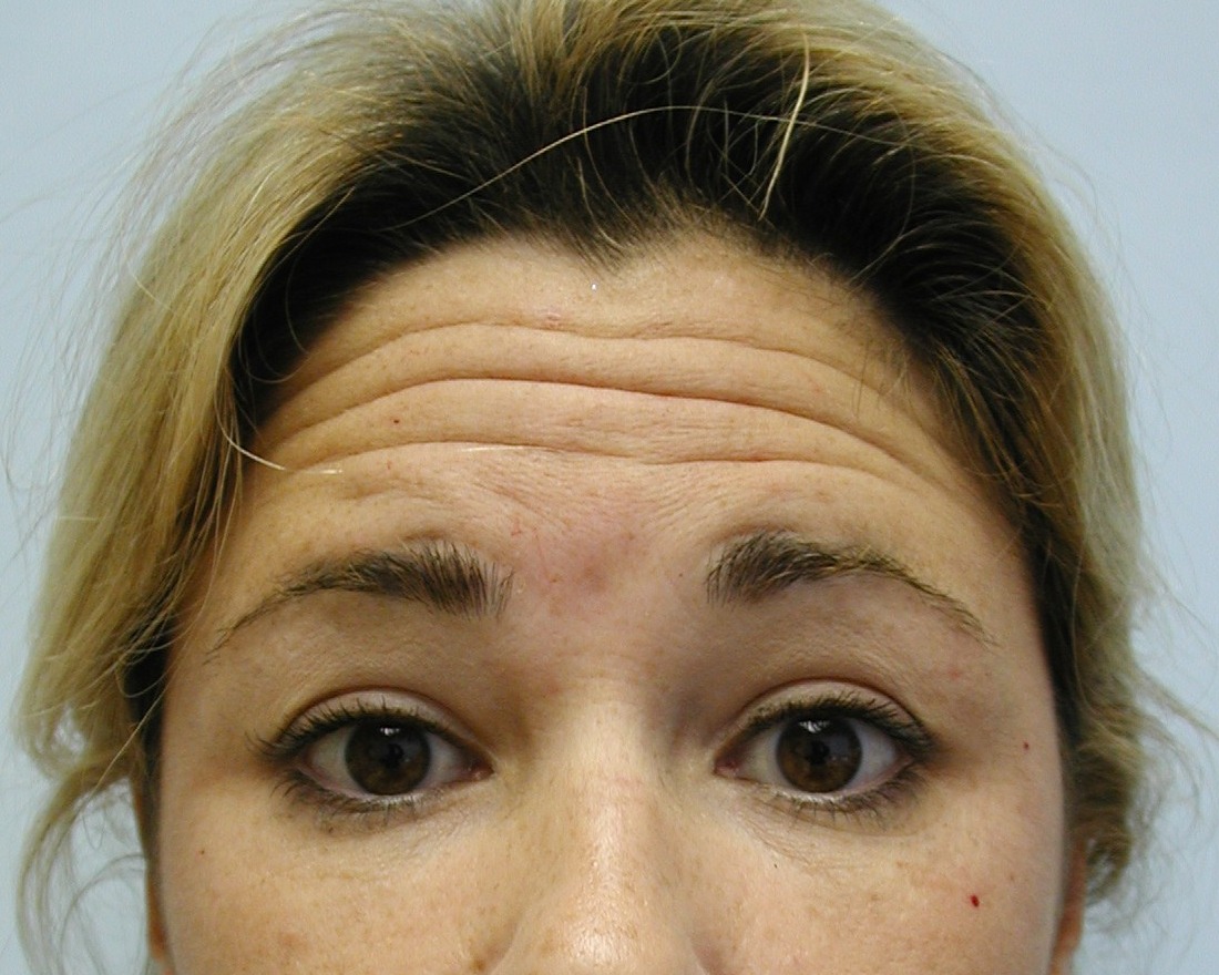 Botox, Before
