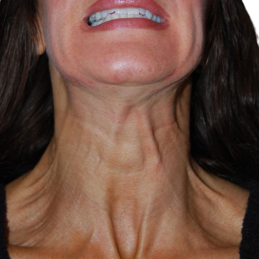 Botox, Before