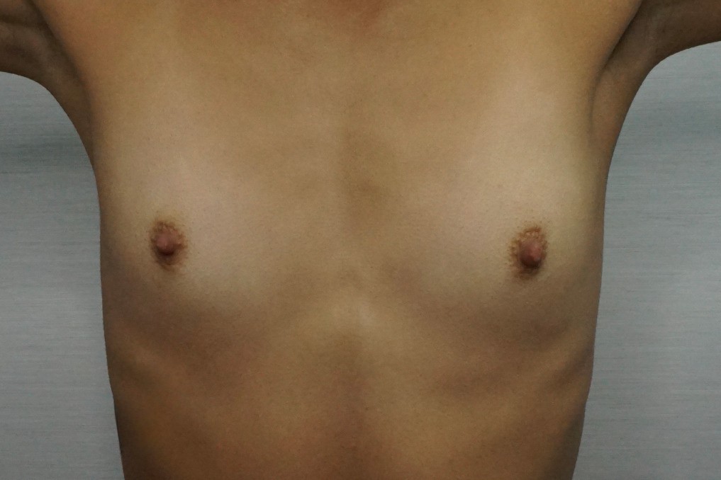 Breast Augmentation Before