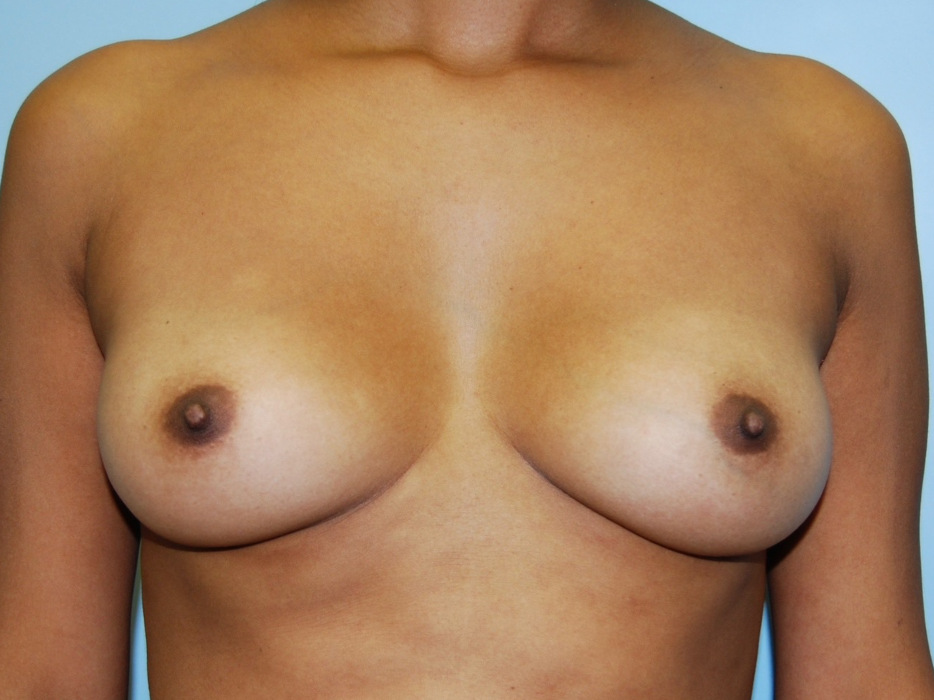 Liposuction Before