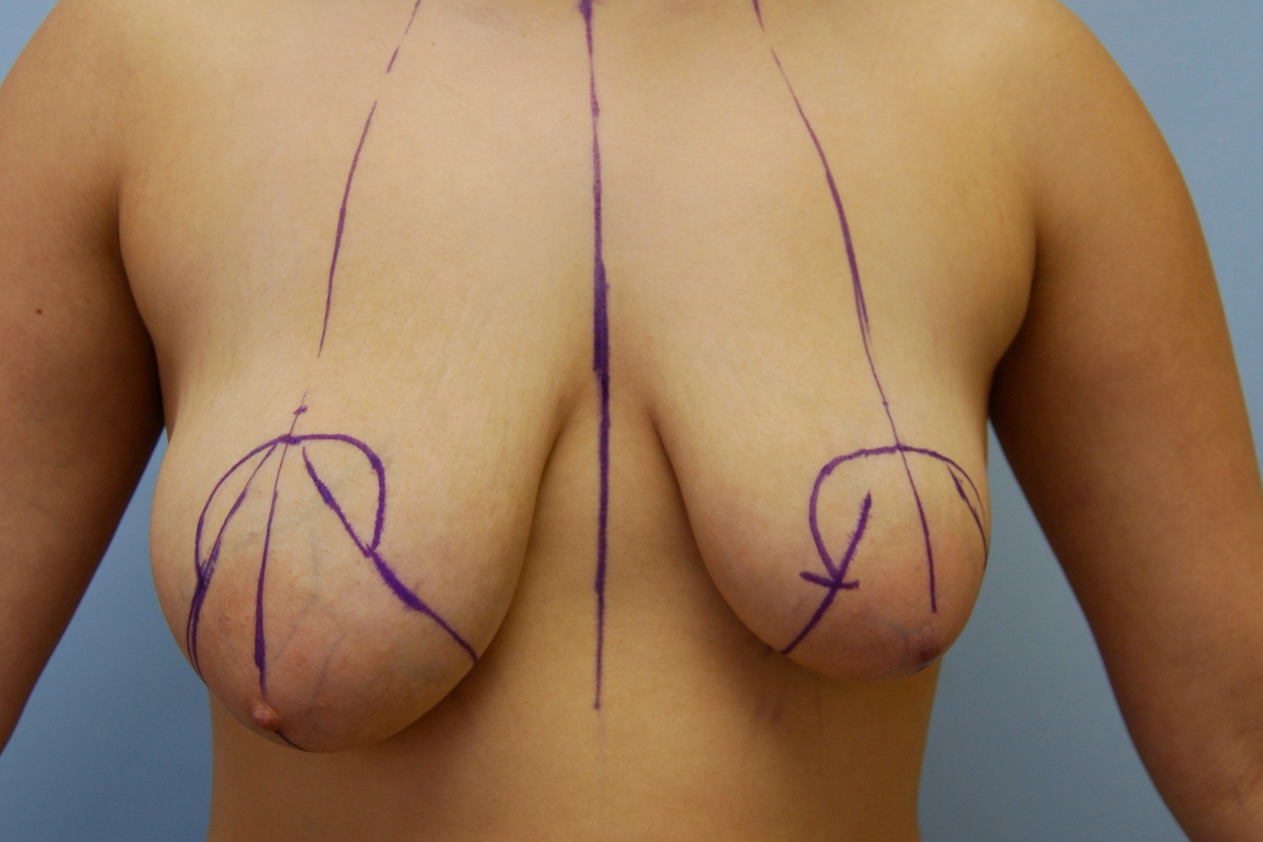 Breast Lift After