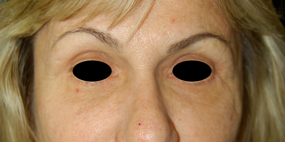 Brow Lift Surgery