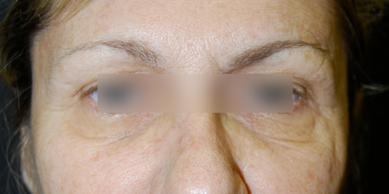 Brow Lift Before