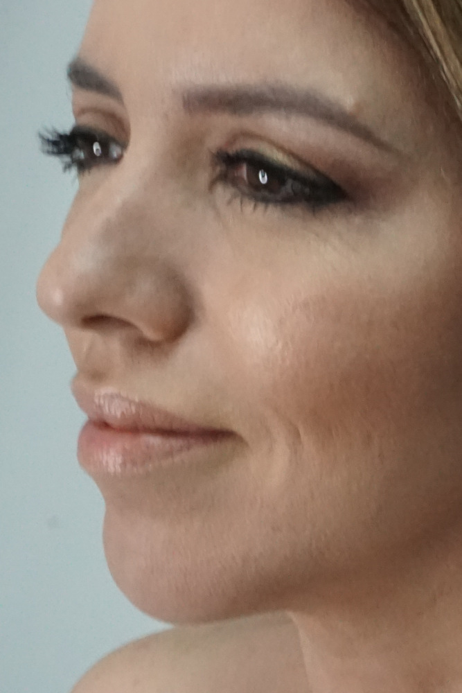 Chin Augmentation & Bichectomy