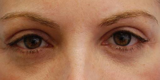 Blepharoplasty (Eyelid Surgery)