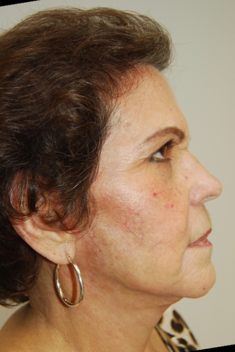 Facelift, After