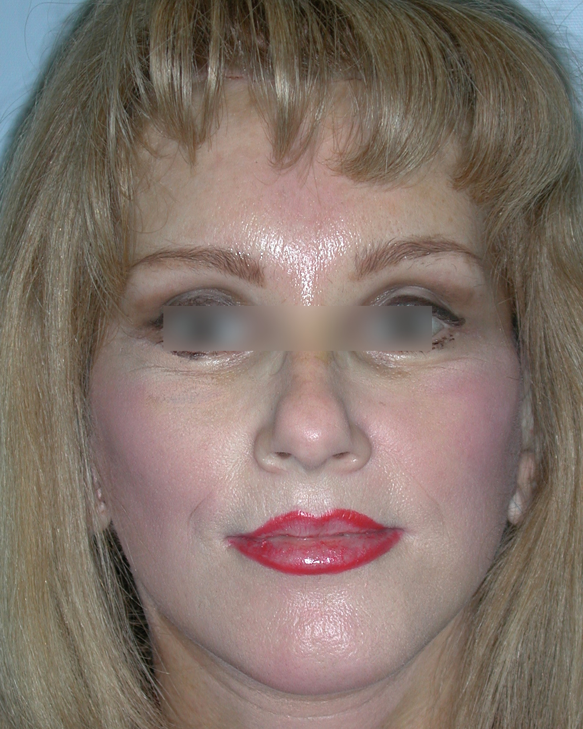 Facelift After