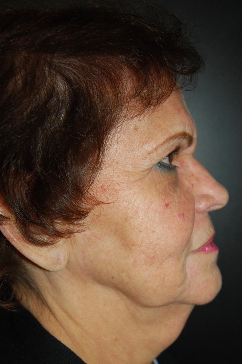 Facelift Before