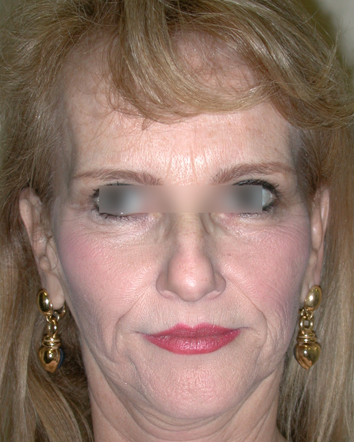 Facelift Before