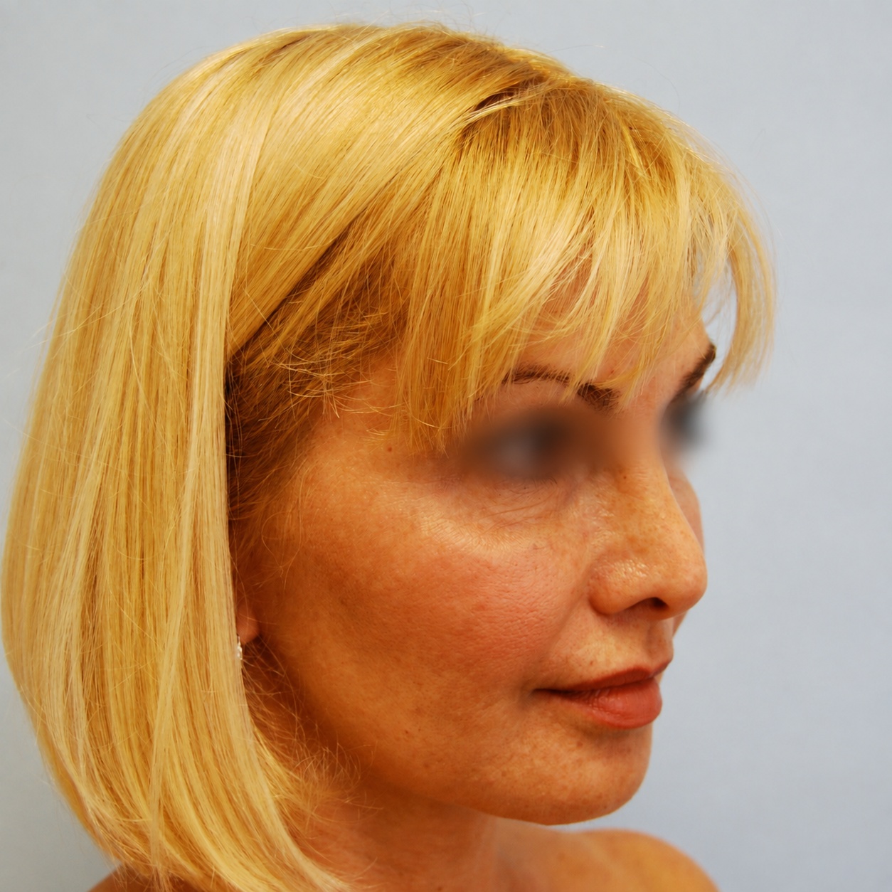 Fat Transfer to Face, After