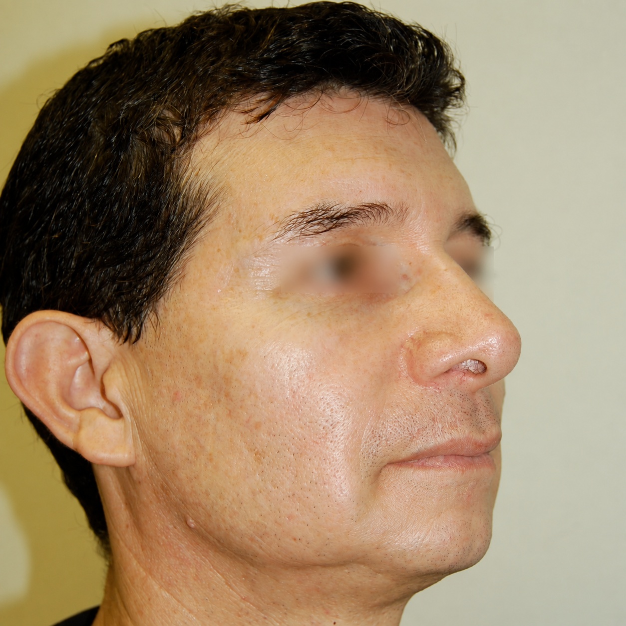 Fat Transfer to Face, After