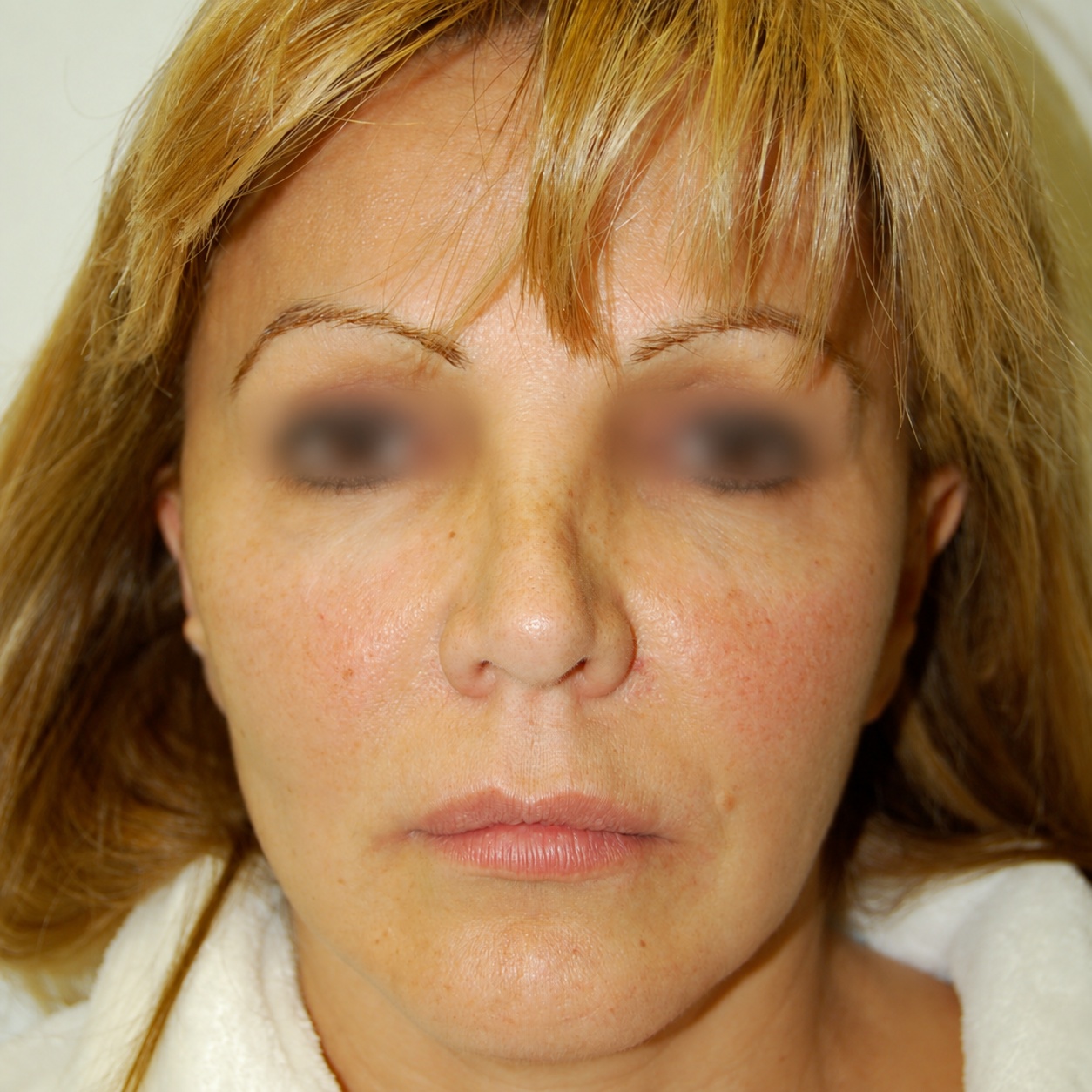 Fat Transfer to Face, After