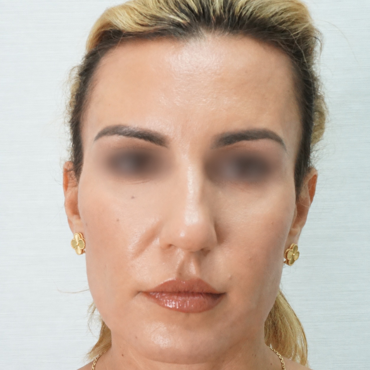 Fat Transfer to Face, After