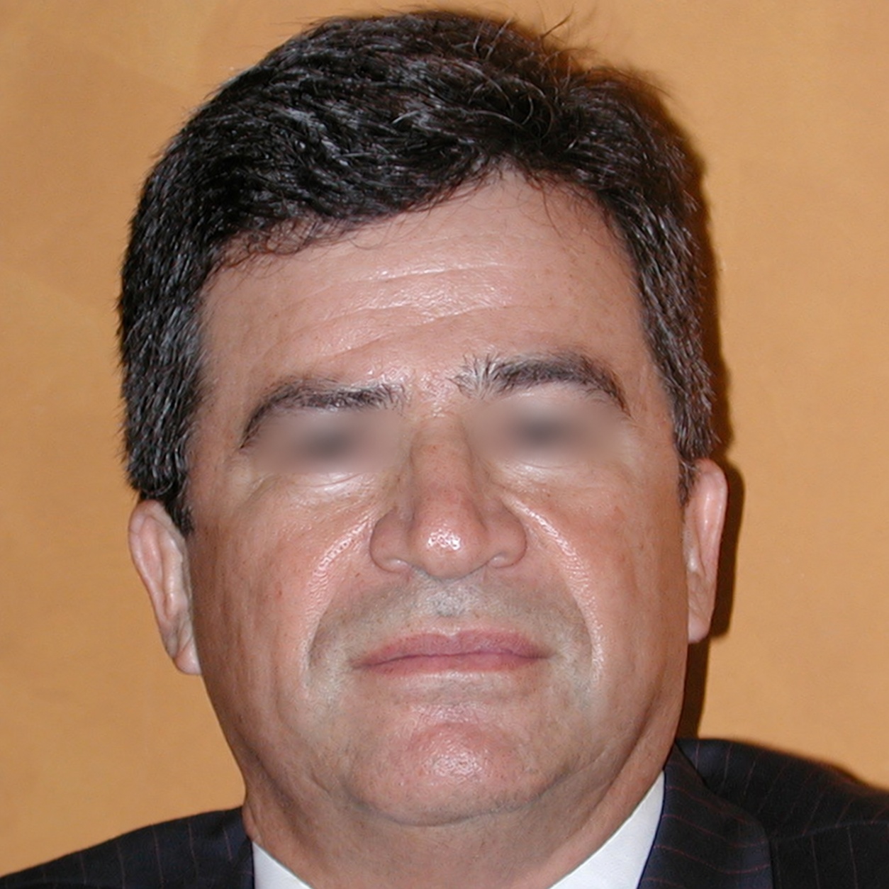Fat Transfer to Face, After