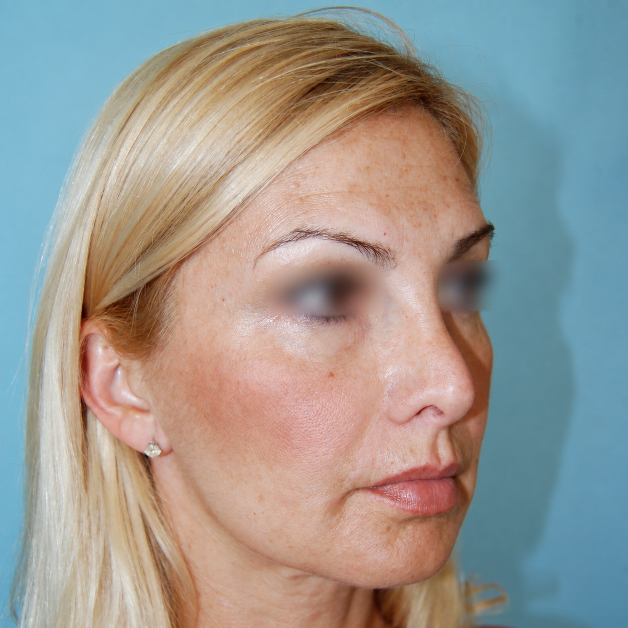 Fat Transfer to Face, Before