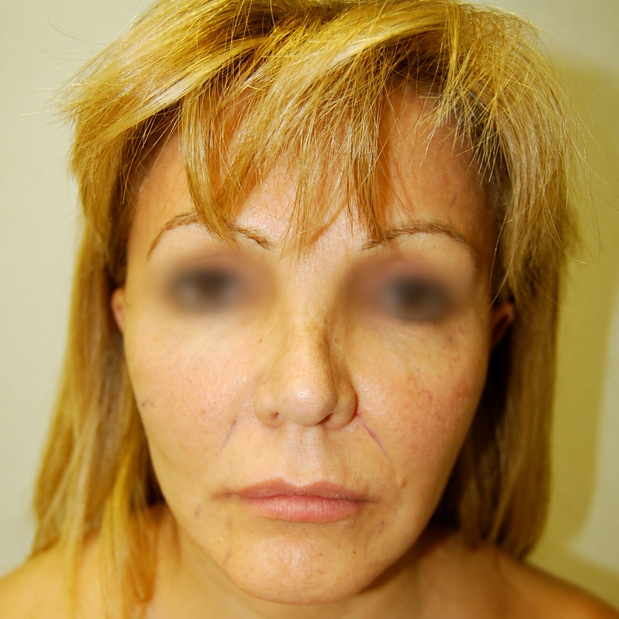 Fat Transfer to Face, Before