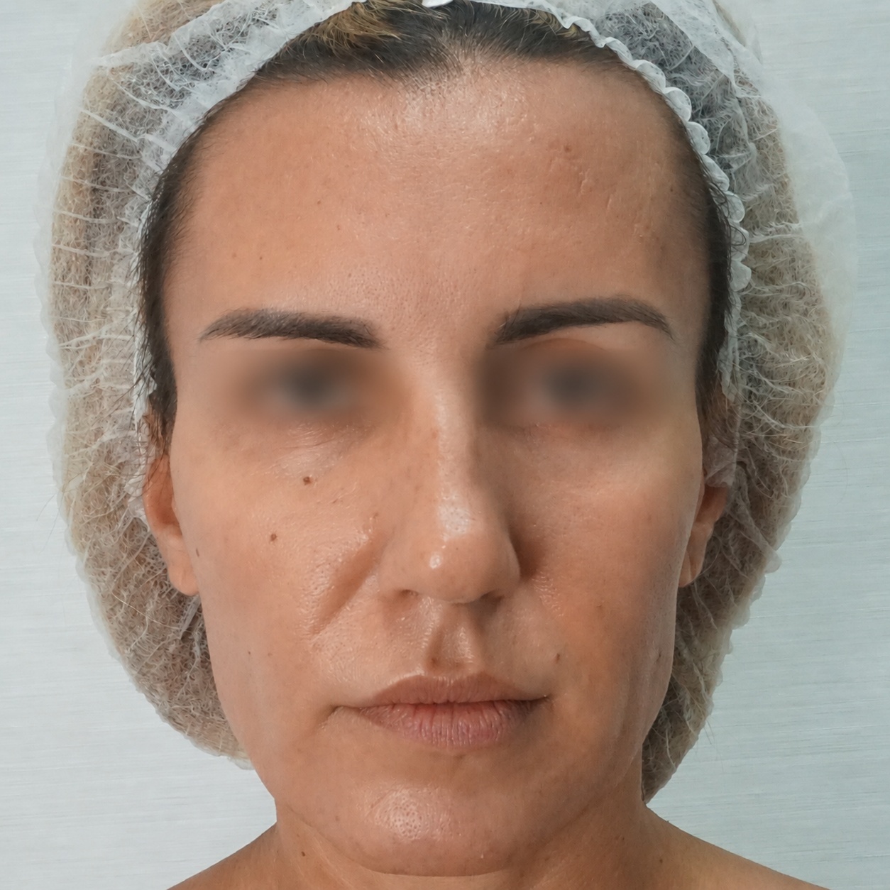 Fat Transfer to Face, Before