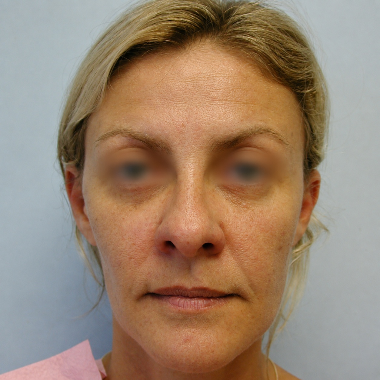 Fat Transfer to Face, Before