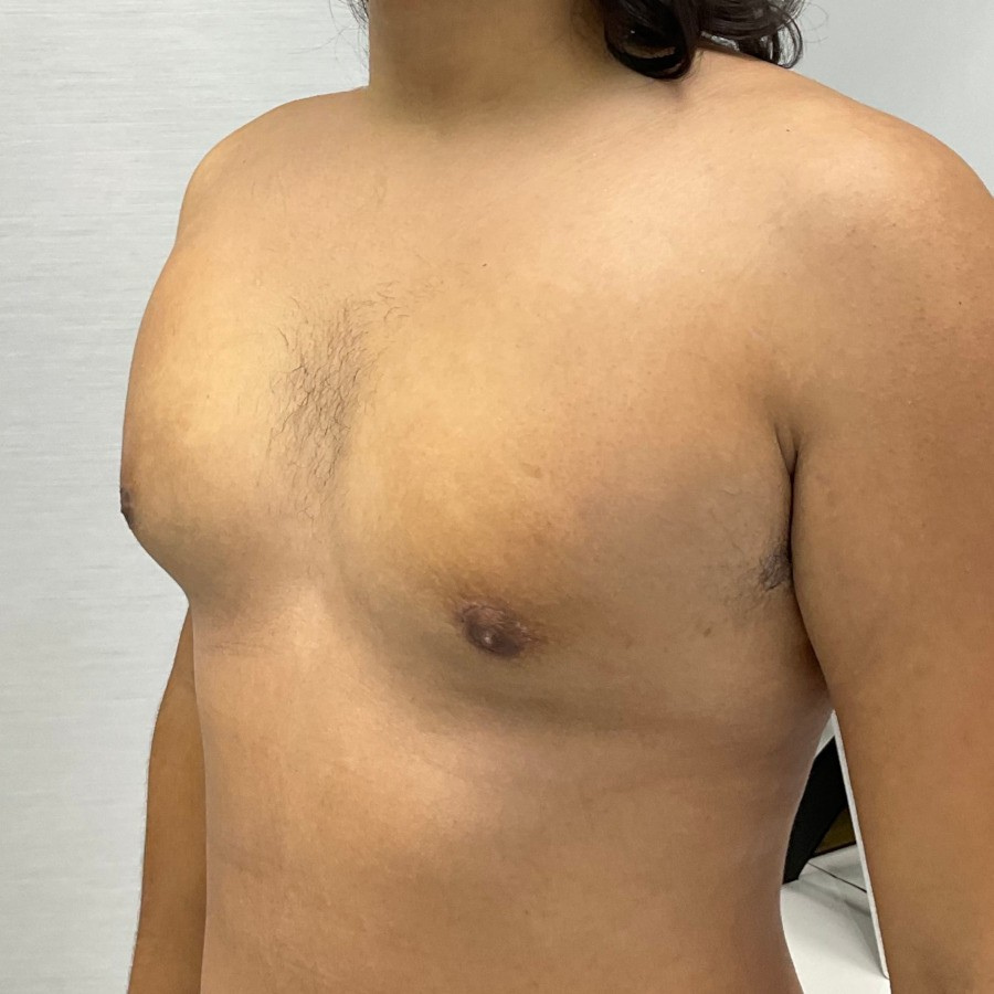 Cirurgia de Ginecomastia