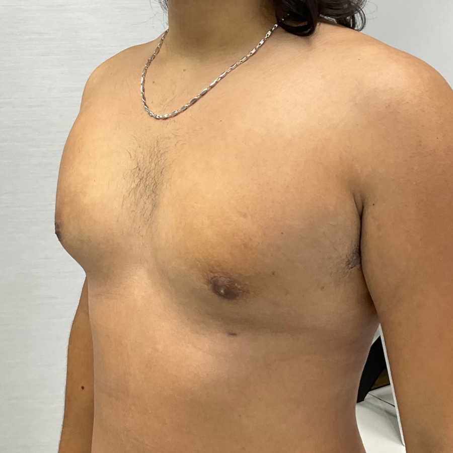 Gynecomastia After