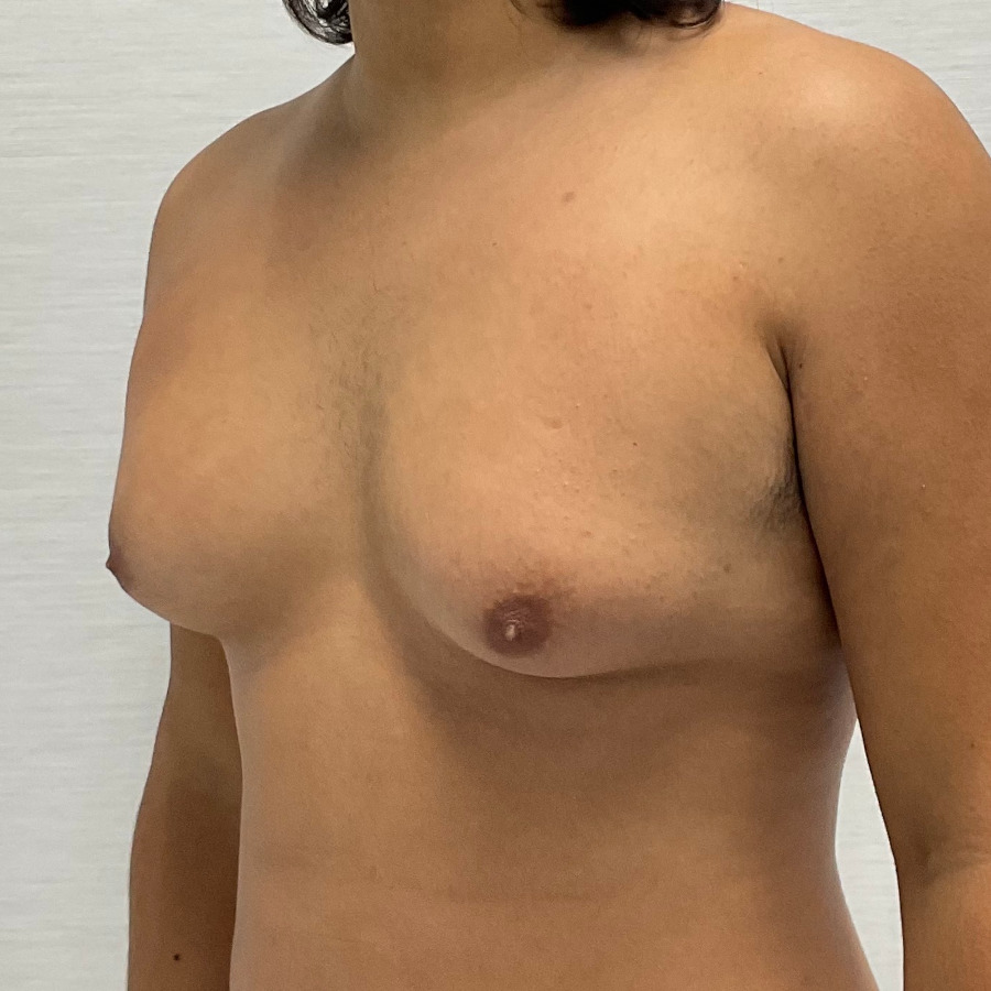 Gynocomastia Before