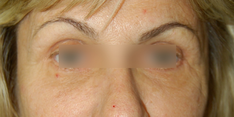 Levantamiento de Cejas