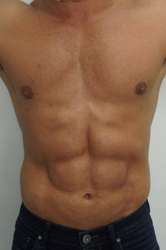 Liposculpture After