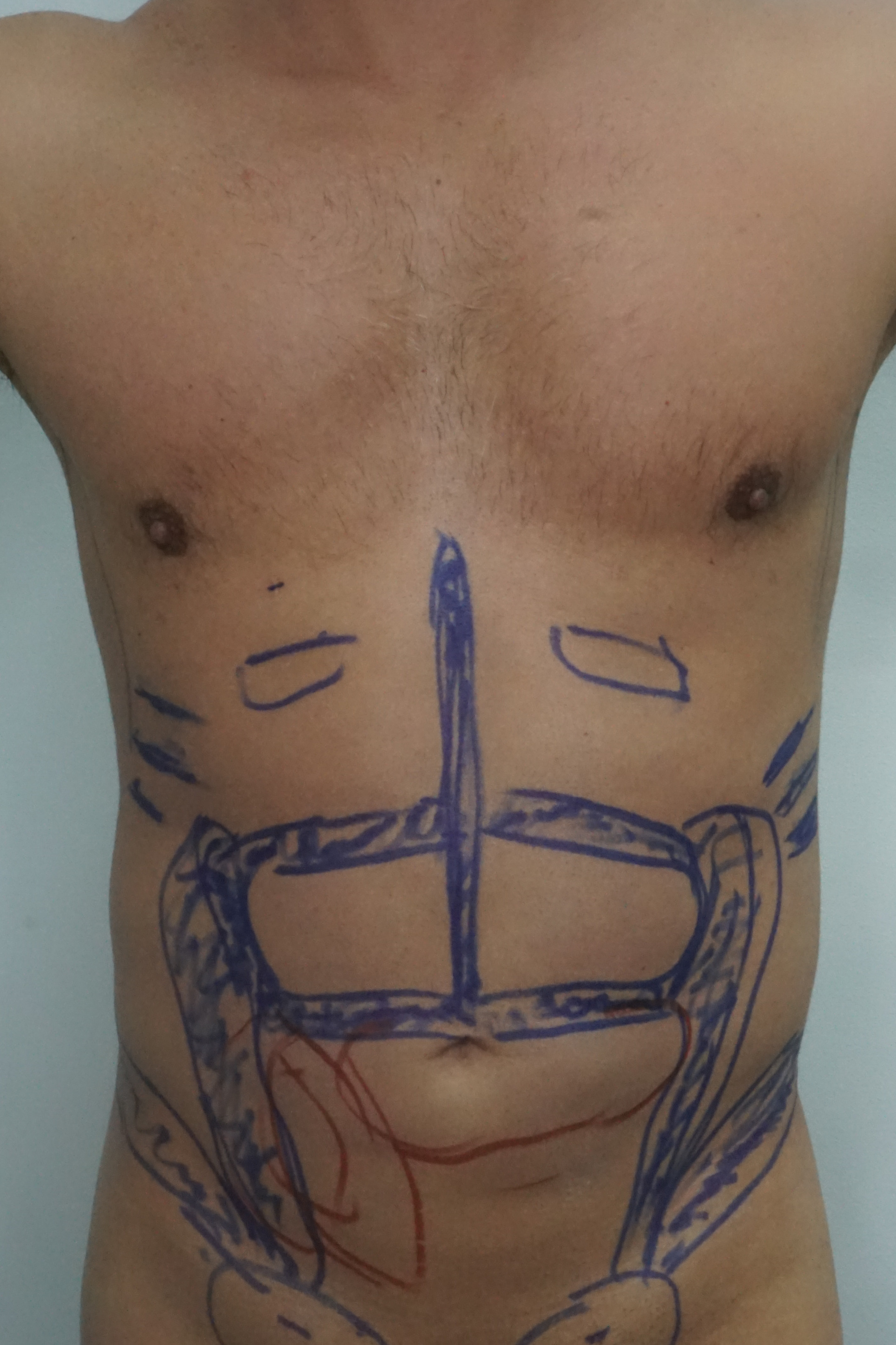 Liposculpture Before