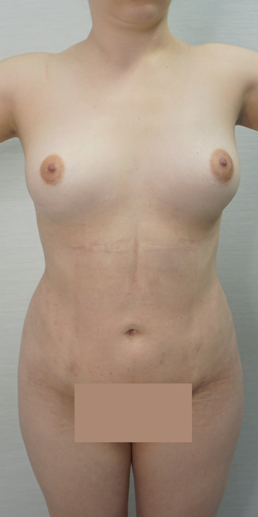 Liposuction After