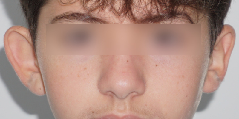 Otoplasty Before