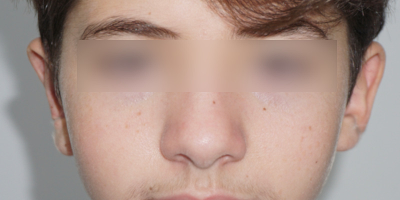 Otoplasty <br> (Ear Surgery)