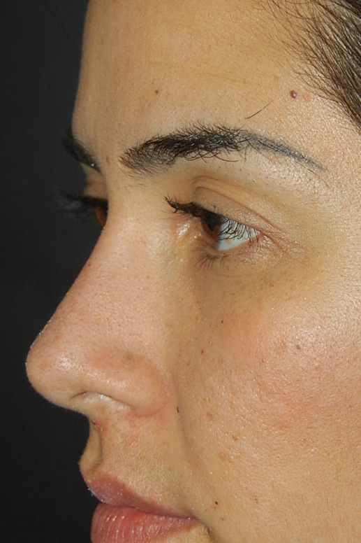 Rinoplastia, Después