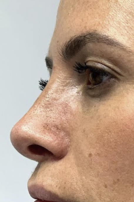 Rinoplastia, Después