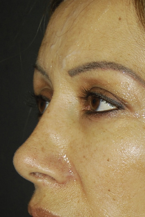 Rinoplastia, Después