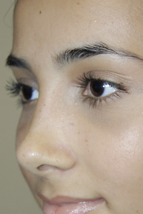 Rinoplastia, Después