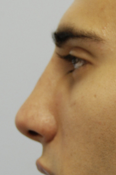 Rinoplastia, Después