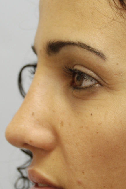 Rinoplastia, Después