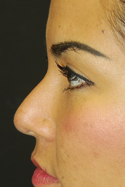Rinoplastia, Antes