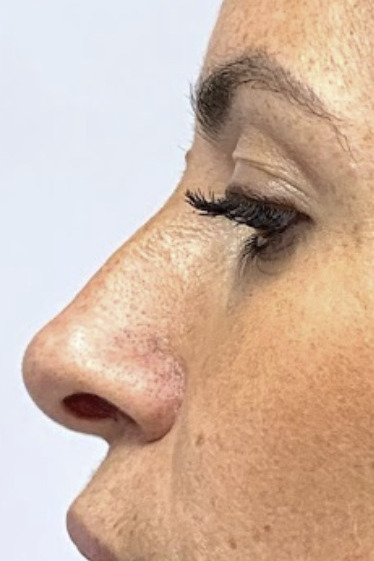 Rinoplastia, Antes