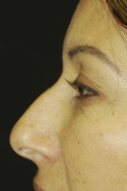Rinoplastia, Antes