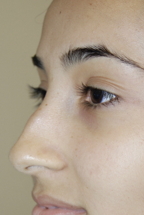 Rinoplastia, Antes