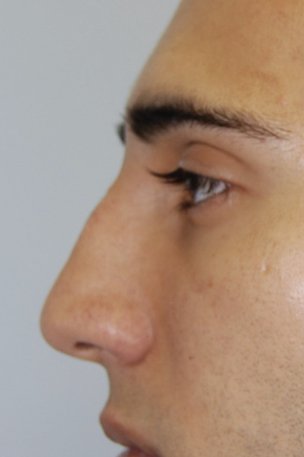Rinoplastia, Antes