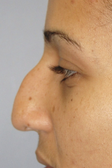 Rinoplastia, Antes