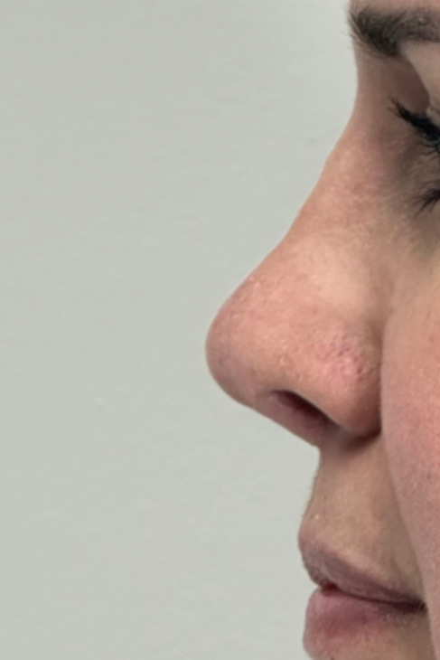 Rhinoplasty After
