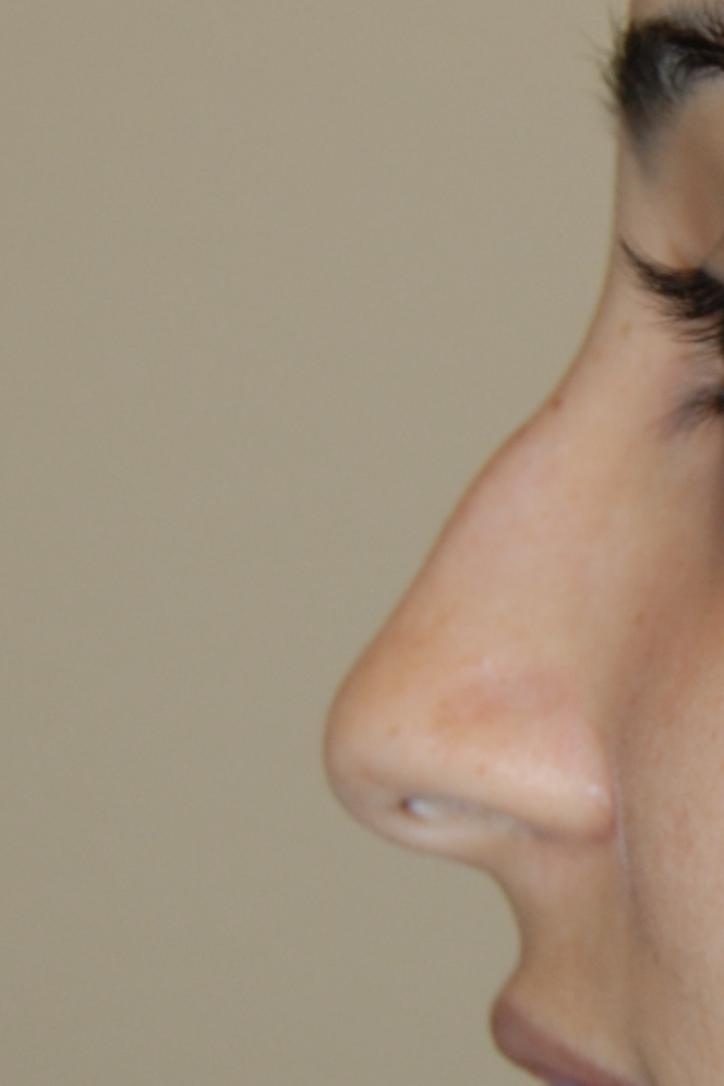 Rhinoplasty Before
