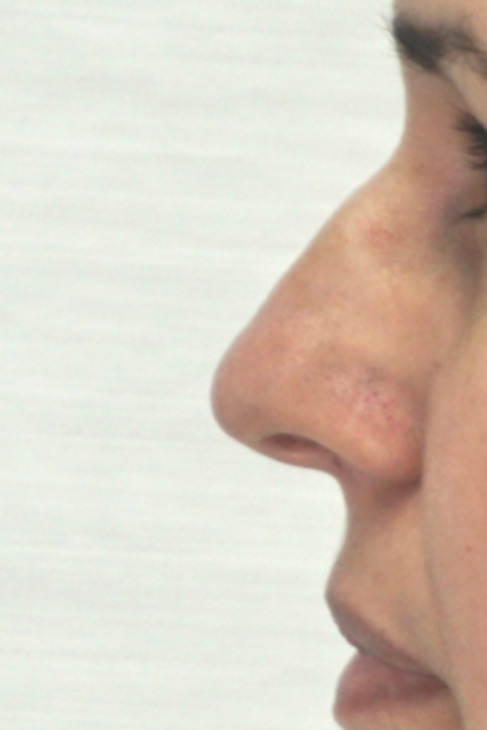 Rhinoplasty Before