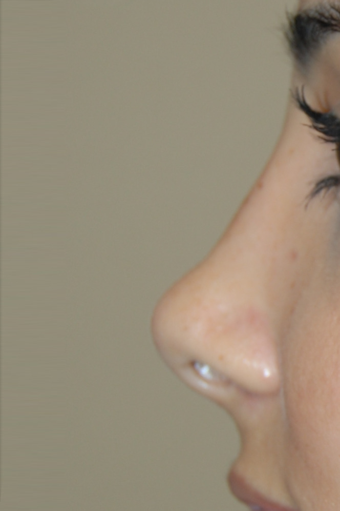 Rinoplastia <br> (Cirurgia do Nariz)